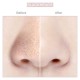 MEACLEAR® • Extracteur de points noirs électrique • Hommes & Femmes