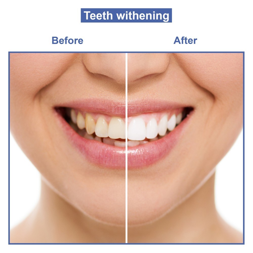 MEAWHITE • Kit Recharge 3 SERINGUES 10ml pour blanchiment des dents à domicile • 100% SANS peroxyde • Gel blanchissant dentaire