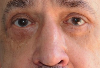 Blépharoplastie - chirurgie des paupières après