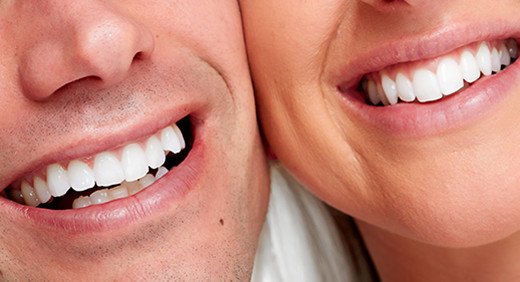 10 questions sur les facettes dentaires