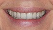 Sourire : Facettes dentaires après