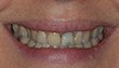 Sourire : Facettes dentaires avant