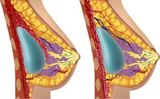 Placement des implants mammaires